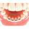 Dental Orthodontic Lingual Bondable Bite Opener Turbos / Orthodontic Bondable Hinge Opener Tongue SE-O141 supplier