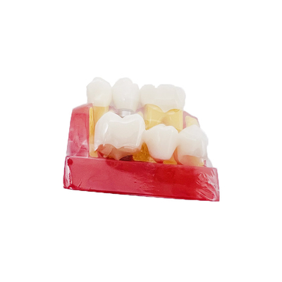 Dental Teaching Products 4 Times Implant Model Teeth Implant Analysis Tooth Model for Patients Communication supplier