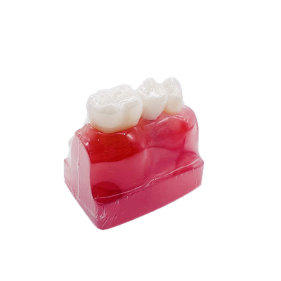 Dental Teaching Products 4 Times Implant Model Teeth Implant Analysis Tooth Model for Patients Communication supplier