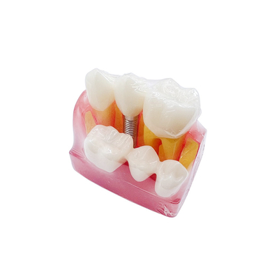Dental Teaching Products 4 Times Implant Model Teeth Implant Analysis Tooth Model for Patients Communication supplier