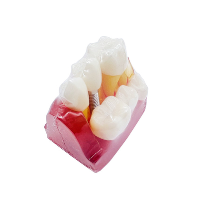 Dental Teaching Products 4 Times Implant Model Teeth Implant Analysis Tooth Model for Patients Communication supplier