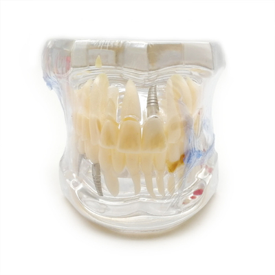 Oral Pathology Teaching Doctor-Patient Comprehensive Prosthesis Dental Restoration Implant Model supplier