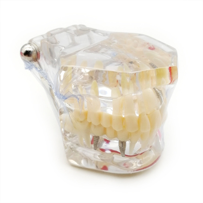Oral Pathology Teaching Doctor-Patient Comprehensive Prosthesis Dental Restoration Implant Model supplier