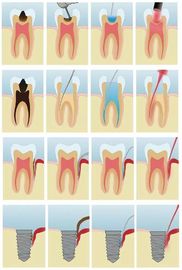 Dental Low Level Laser therapy Photo-activated Disinfection ( PAD ) Light /Diode Heal Laser SE-E045 supplier