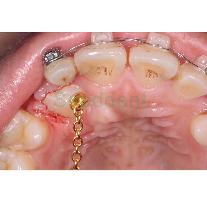 Orthodontic Round Mesh Base Goldplating Lingual Button Chain